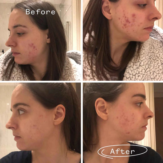 Instant Kalmer | PAI SKINCARE